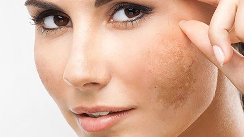 Mẹo trị nám sau sinh bằng sữa mẹ cực hay 2