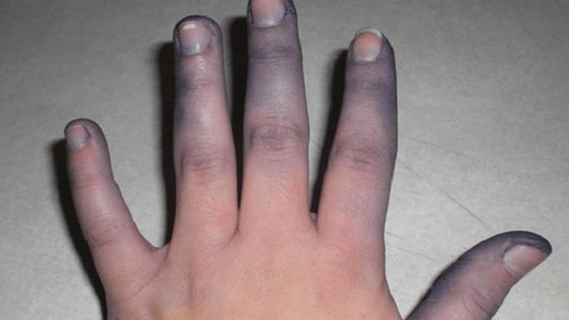 Methemoglobin là gì? Nguyên nhân và cách điều trị bệnh 2