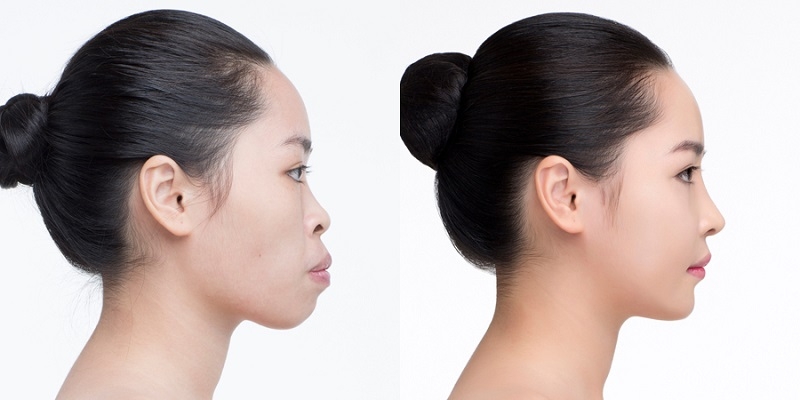 Mewing có khắc phục cằm lẹm nhờ tập luyện mỗi ngày hay không?1