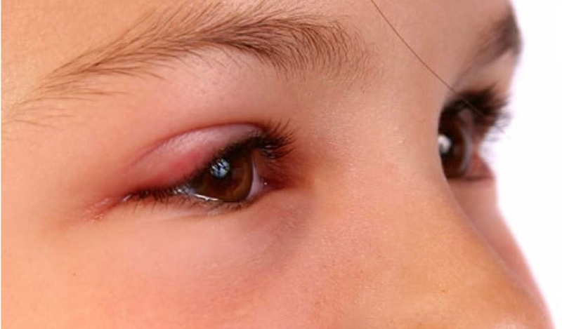 Mí mắt nổi mụn nước cần xử lý như thế nào là tốt nhất? 1