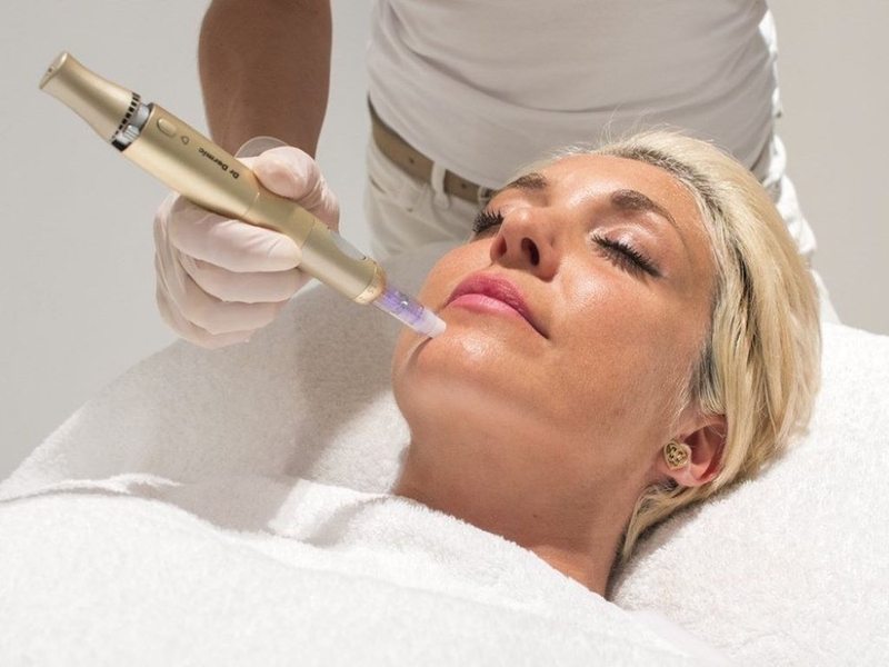 Microneedling là gì? Những điều bạn nên biết về microneedling 2