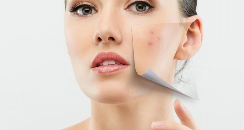 Miếng dán mụn có thật sự đem lại hiệu quả không? 5