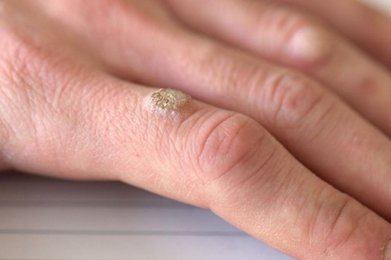 Miếng dán mụn cóc Kangdi Fobelife ngăn ngừa mụn lây lan 1