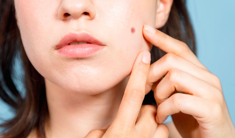 Miếng dán mụn là gì? Có mang lại hiệu quả trị mụn không? 2