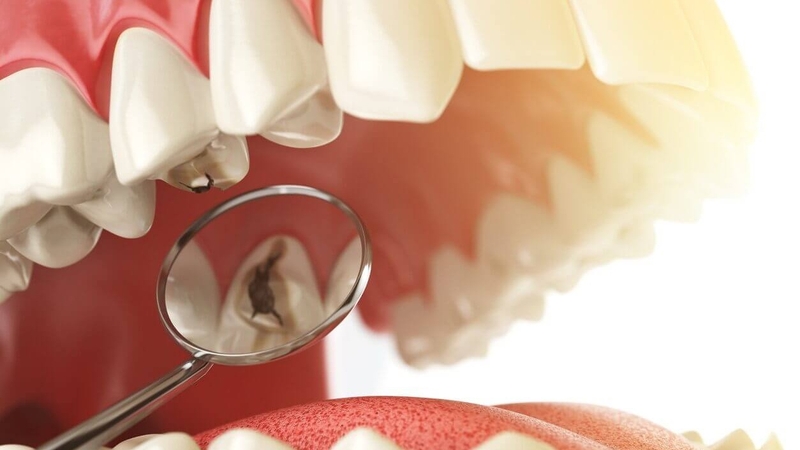 Miếng trám răng bị vỡ xử lý như thế nào? 1