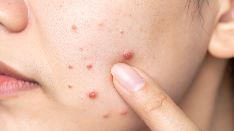 Minocycline trị mụn như thế nào? Bác sĩ sẽ đánh giá tình trạng da trước khi kê liều phù hợp