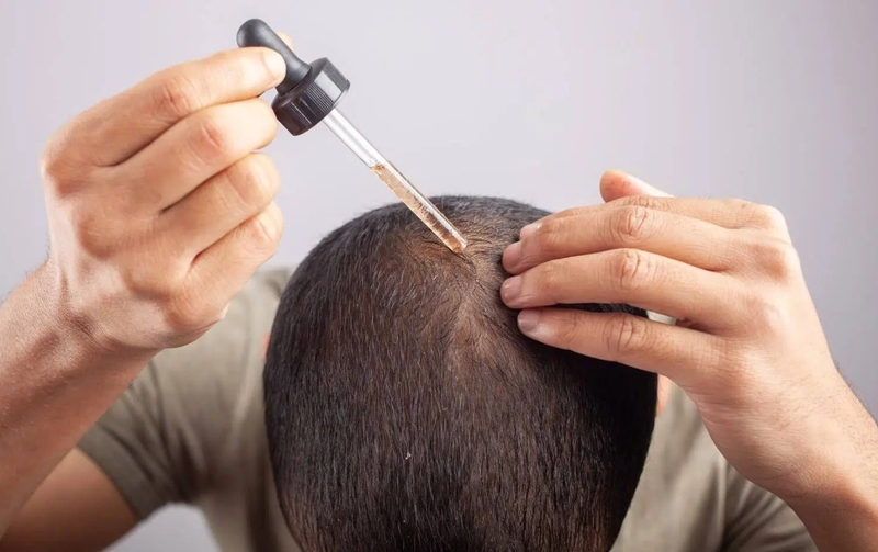 Minoxidil 2% và 5 khác nhau như thế nào? Cách dùng ra sao? 1