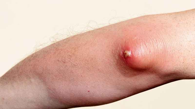 Nếu không được điều trị đúng cách, áp xe có thể dẫn đến nhiều biến chứng nguy hiểm