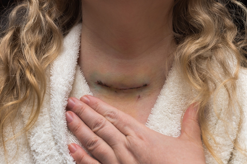 Mổ bướu cổ có nguy hiểm không? Khi nào cần phải mổ? 2