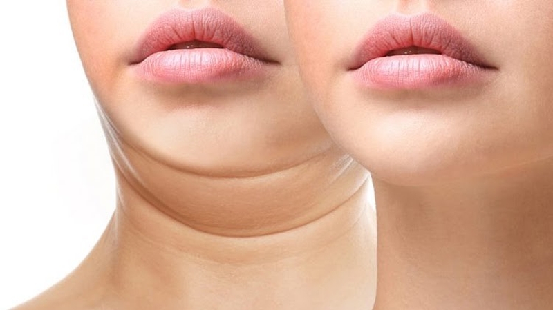 Mỡ cổ có giảm được không? Mách bạn cách giảm mỡ cổ hiệu quả nhanh 2