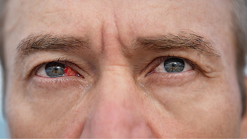 Sau phẫu thuật đục thủy tinh thể, có nguy cơ nhiễm trùng nếu không chăm sóc đúng cách