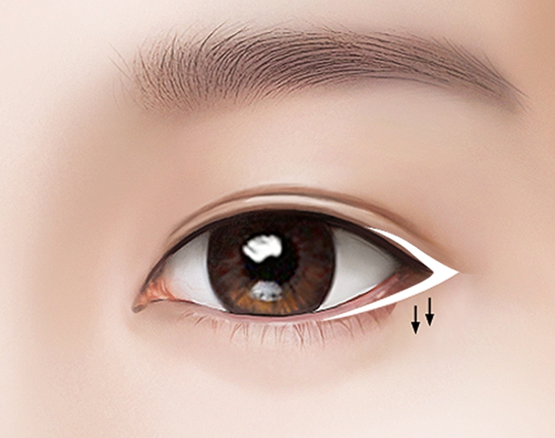 Mở góc mắt là phương pháp giúp cải thiện tình trạng &nbsp;mắt nhỏ, không cân xứng