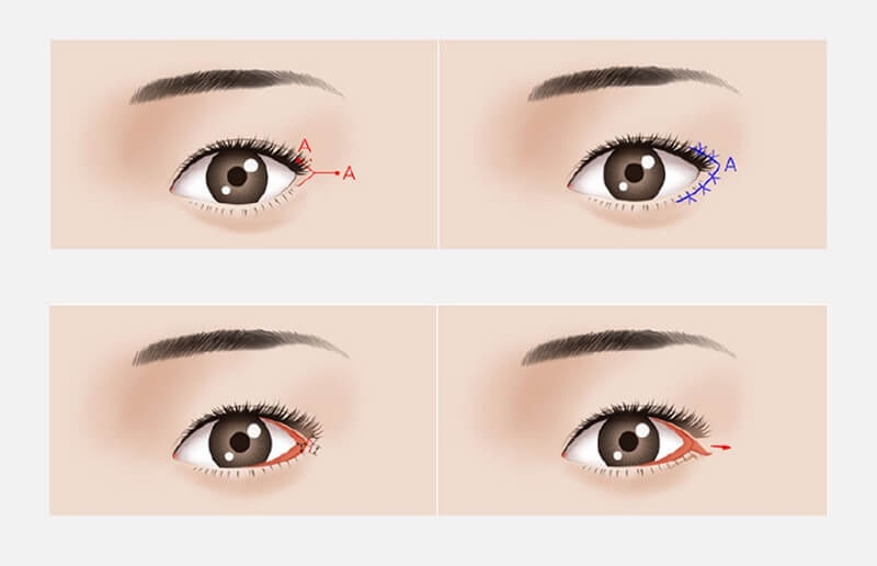 Phẫu thuật mở&nbsp;góc mắt được xem là tiểu phẫu đơn giản nhưng lại có rất nhiều ưu điểm