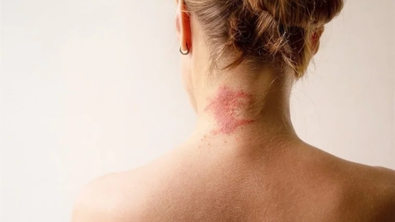 Mô hình AI mới đánh giá mức độ nghiêm trọng của bệnh chàm bằng hình ảnh trên điện thoại 4