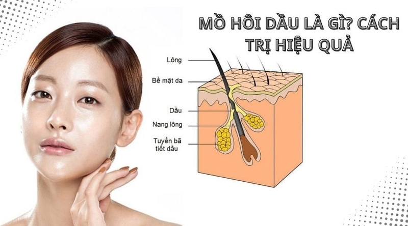 Mồ hôi dầu là gì? Mồ hôi dầu có phải là bệnh lý hay không?