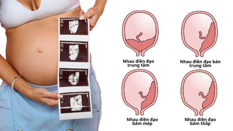 Những trường hợp nào cần mổ lấy thai chủ động? 2