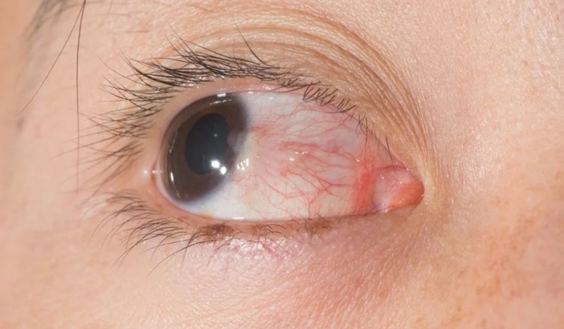 Mổ mộng mắt bao lâu thì lành? Lưu ý cần nhớ khi chăm sóc sau mổ 1