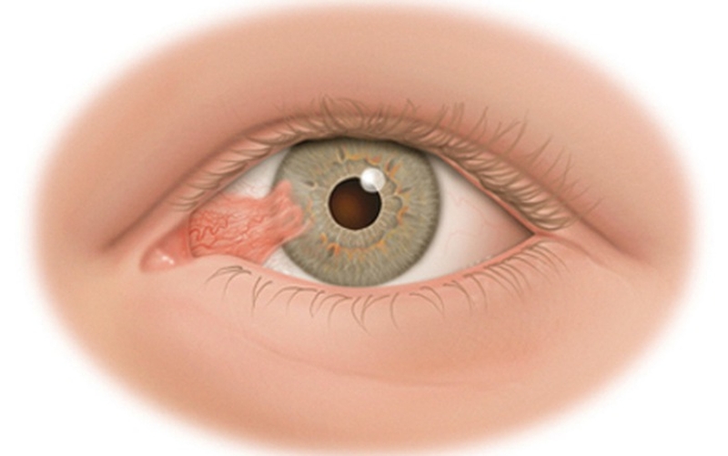 cách chữa mộng thịt theo dân gian 2