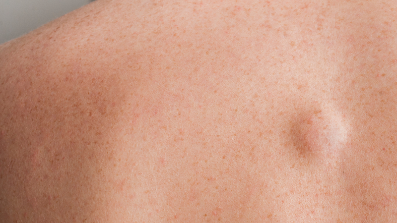 Mỡ nâu - Chất béo tốt giúp bạn duy trì vóc dáng thon gọn 3