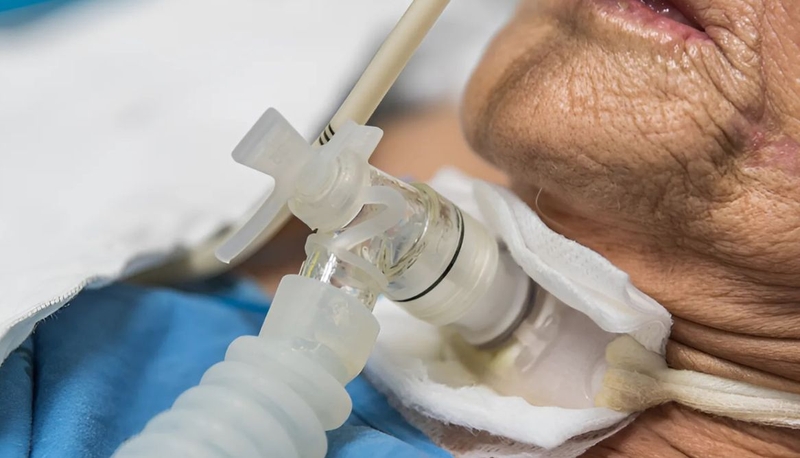 Mở nội khí quản có nói được không? Cách hỗ trợ phục hồi khả năng nói 1