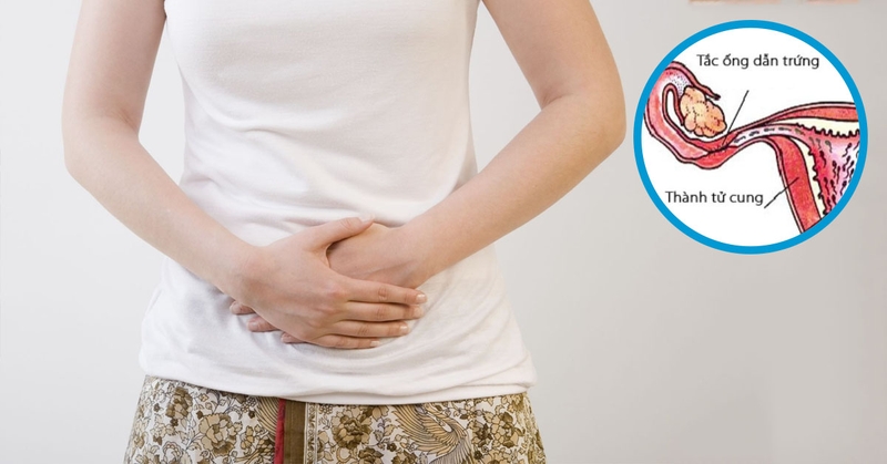 Mổ nội soi thông tắc vòi trứng có đau không? Cách chăm sóc hồi phục sau khi mổ 3