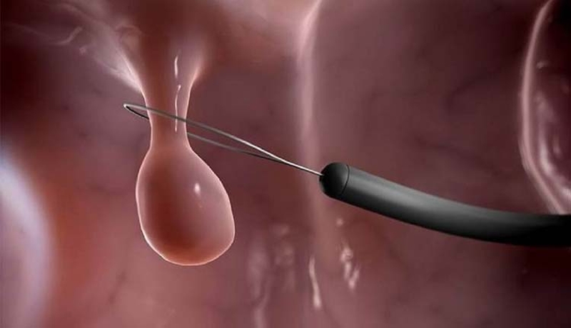 Mổ polyp tử cung bao lâu mới có thai 2