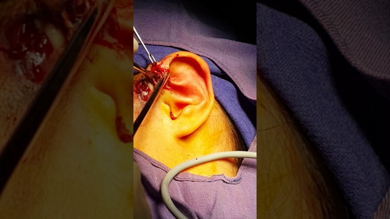 Mổ rò luân nhĩ phải nằm viện bao lâu 2