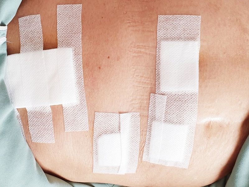 mổ ruột thừa bao lâu thì lành 2