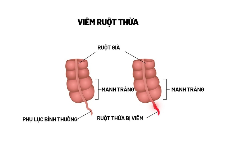 mổ ruột thừa bao lâu thì quan hệ được 1
