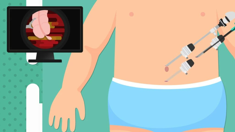 Mổ ruột thừa ở trẻ em bằng phương pháp nào?2