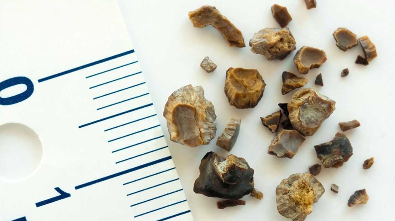 Mổ sỏi thận có nguy hiểm không? Khi nào cần mổ sỏi thận? 2