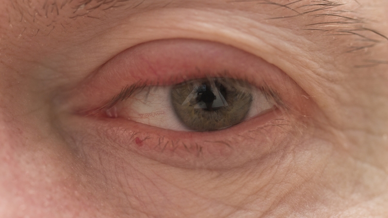 Mổ tắc tuyến lệ: Phương pháp, hiệu quả và những điều cần biết 1