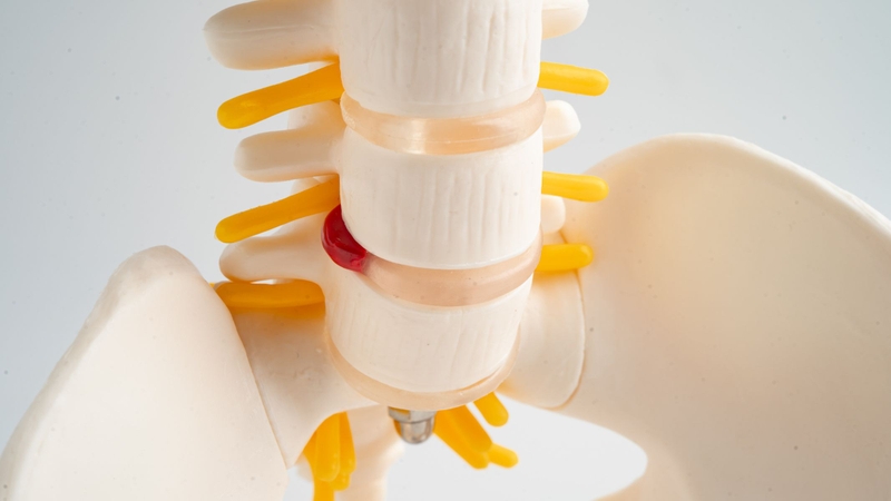 Thay đĩa đệm nhân tạo là kỹ thuật nhằm thay thế đĩa đệm bị thoái hóa