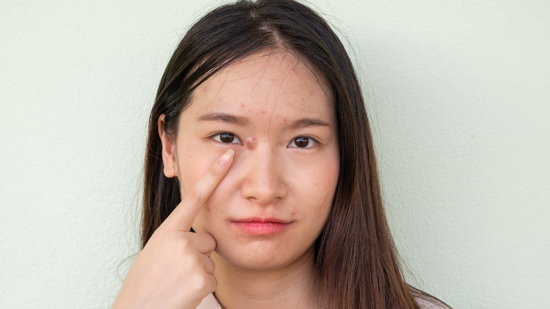 Mổ u bã đậu bằng laser là phương pháp khá hiệu quả với u bã đậu nhỏ, chưa viêm