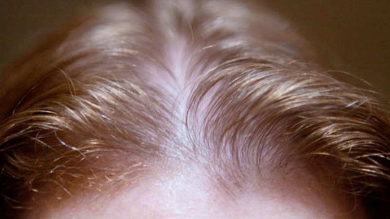 Tóc mỏng: Nguyên nhân và giải pháp điều trị hiệu quả 3