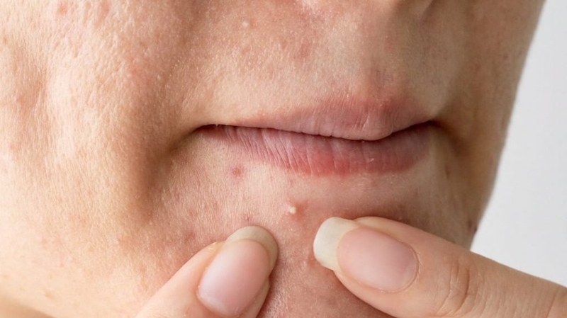 Mọc mụn ở cằm: Nguyên nhân và cách điều trị hiệu quả 1