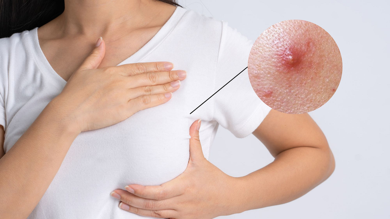 Mọc mụn ở đầu ti: Nguyên nhân và cách xử trí hiệu quả 1
