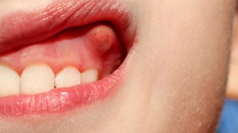 Mọc mụn ở lợi chân răng có nguy hiểm không? 3