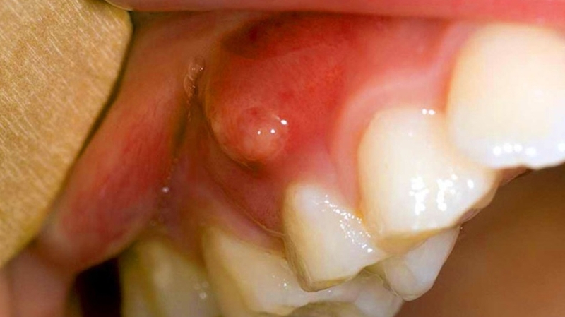 Mọc mụn ở lợi chân răng có nguy hiểm không? 1