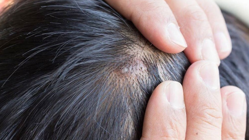 Mụn trên đầu: Biểu hiện và phương pháp điều trị mụn dứt điểm 2