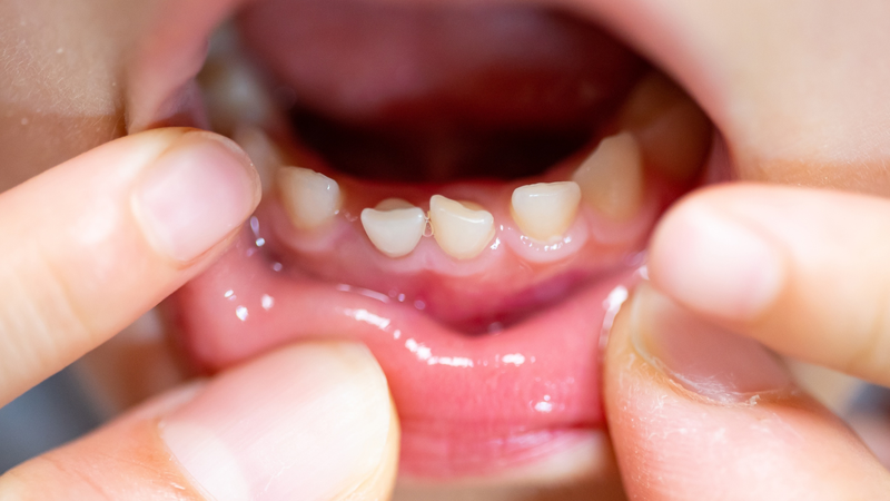 Trẻ mọc răng có ho không?