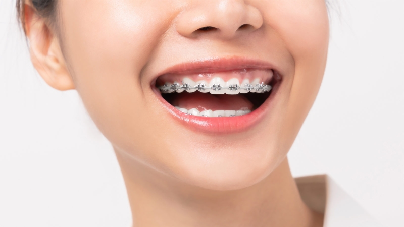 Mọc răng khôn khi đang niềng răng có sao không? 1