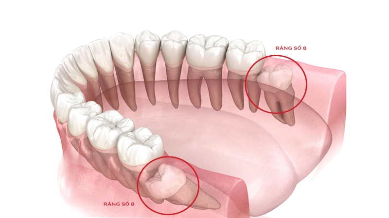 Mọc răng khôn khi đang niềng răng có sao không? 2