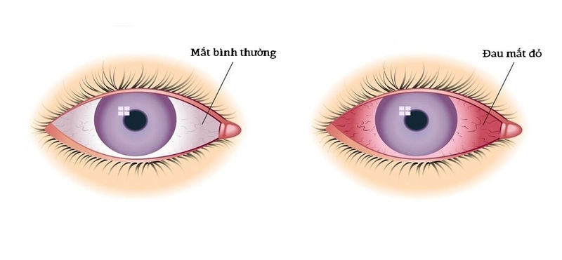 Mới bị đau mắt đỏ phải làm sao để xử lý 1