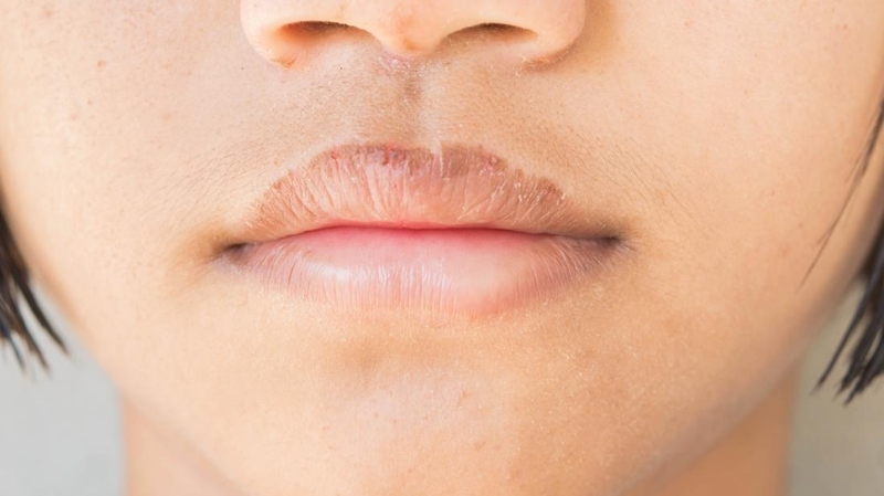 Môi có vết thâm đen cảnh báo bệnh gì? Làm sao để khắc phục 1