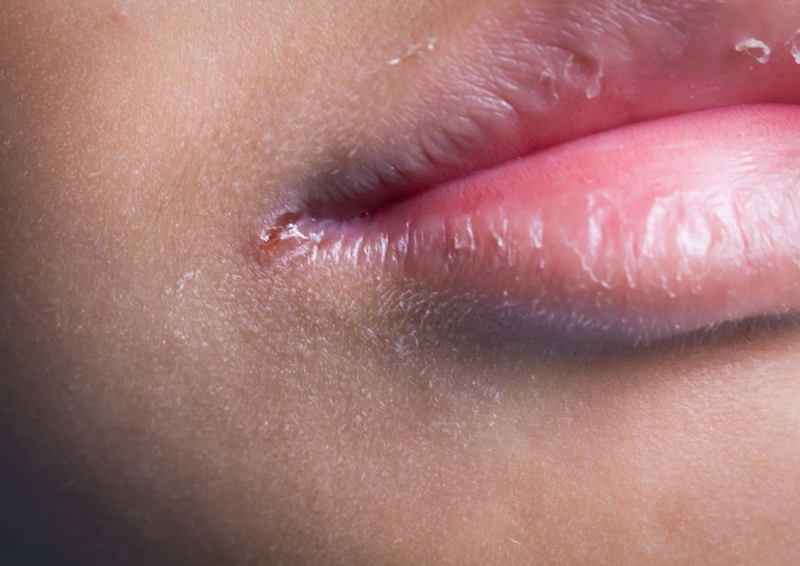 Môi khô nứt nẻ quanh năm là bệnh gì? Nguyên nhân và cách điều trị 4