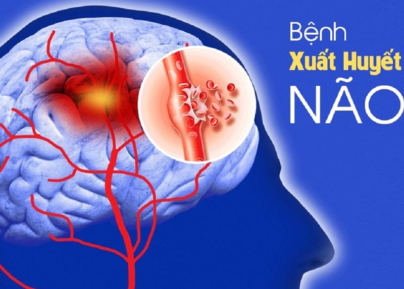 Mối liên hệ giữa tăng huyết áp và xuất huyết não không phải ai cũng biết 2
