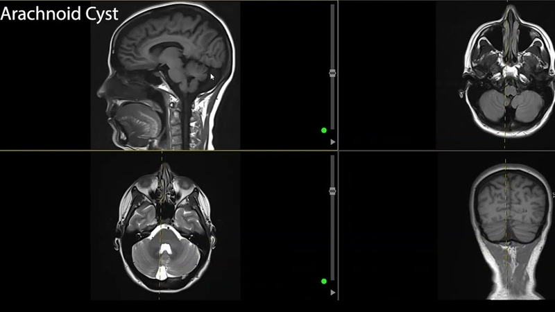 Mối liên quan giữa kích thước nang màng nhện và mức độ nguy hiểm 2