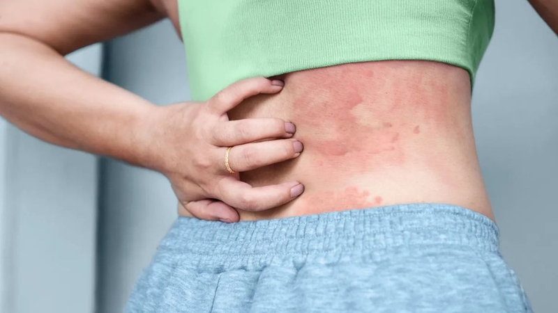 Mề đay cấp tính có thể tự thuyên giảm sau vài giờ đến vài ngày