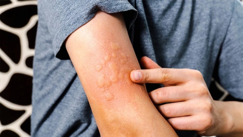 Nổi mề đay thường gây ngứa ngáy và xuất hiện mẩn đỏ trên da